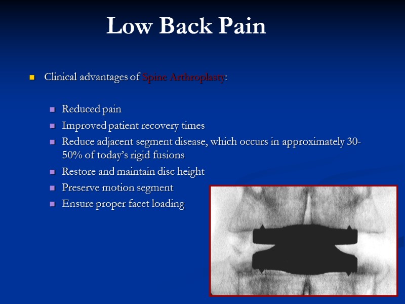 Clinical advantages of Spine Arthroplasty:  Reduced pain Improved patient recovery times Reduce adjacent